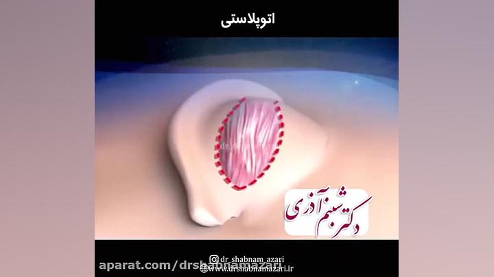 اتوپلاستی ایکلوزوماب