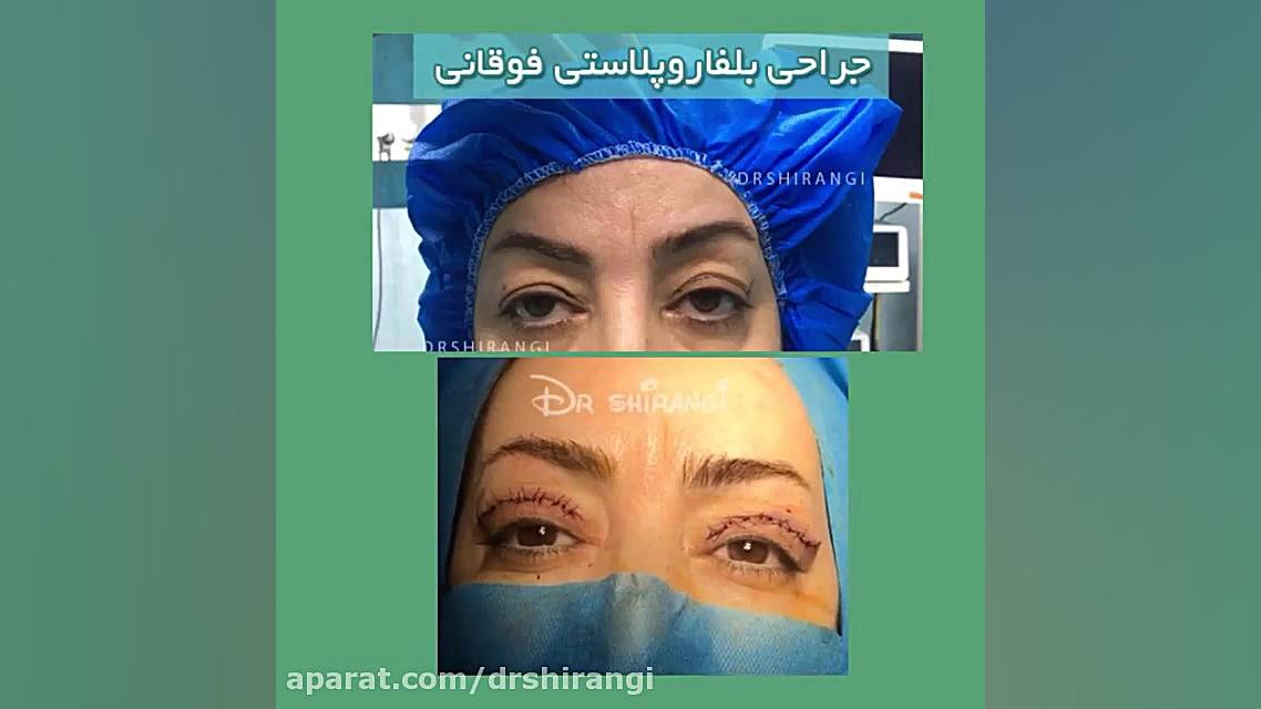 فیلم واقعی خانمی که جراحی بلفاروپلاستی انجام داده است دکتر سعید شیرنگی (فوق تخصص جراحی پلاستیک و زیبایی)
