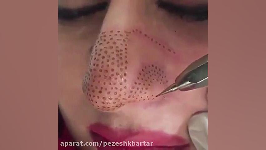 کم حجم کردن و قرینه سازی بینی با دستگاه پلاسما پلاس بدون درد و عوارض کیت وینسلت
