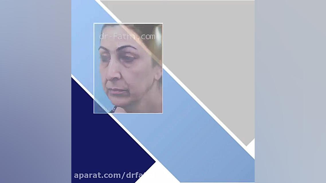 نمونه کار جراحی لیفت صورت دکتر حمید رضا فتحی فوق تخصص جراحی پلاستیک