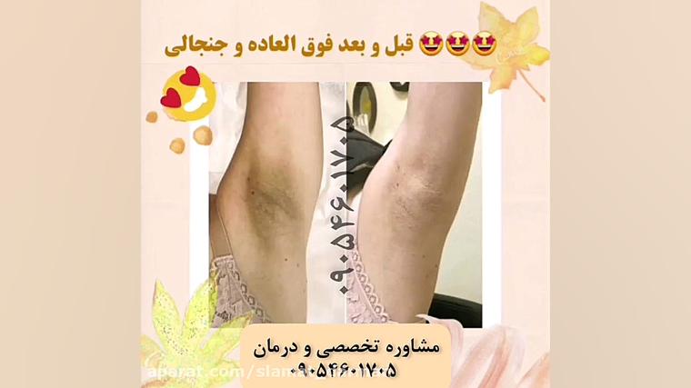 درمان جوش صورت و لکه های پوستی لیفت پیشانی