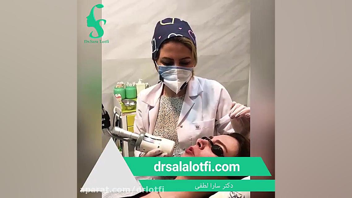 ویدئو رضایت از انجام میکرونیدلینگ برای از بین بردن اسکار دکتر سار ا لطفی