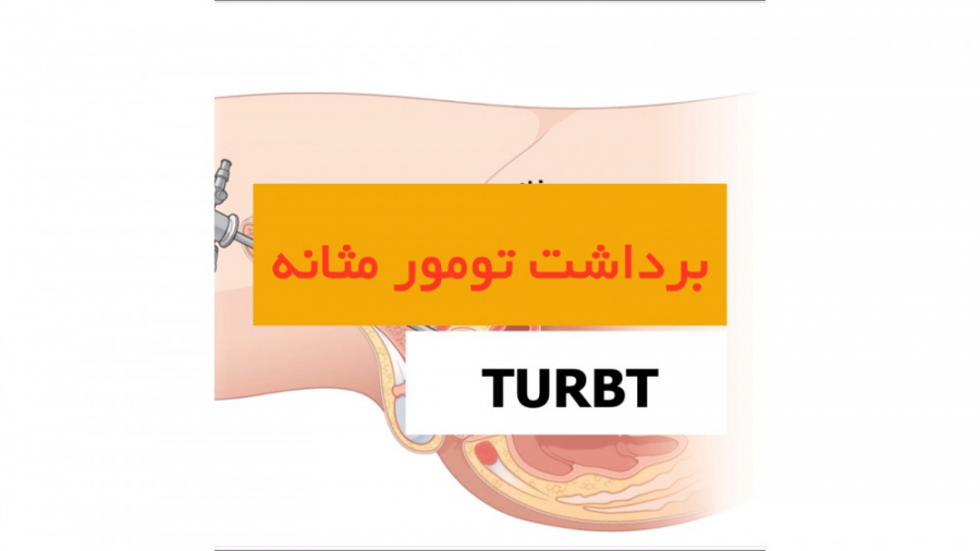 برداشت تومور مثانه (TURBT) - دکتر سید امین میر صادقی ترمیم ونیر