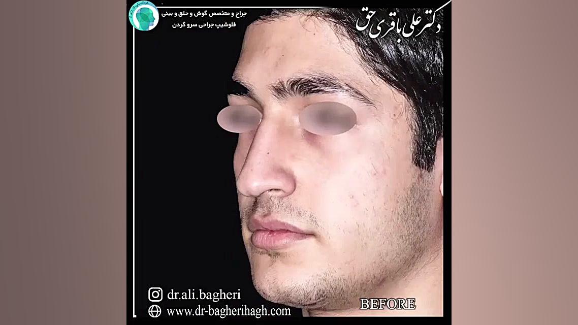 نمونه جراحی زیبایی بینی آقایان | دکتر باقری حق دکتر علی باقری حق