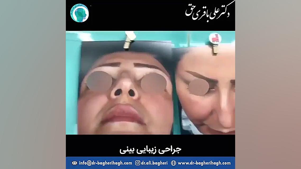 نمونه جراحی زیبایی بینی | دکتر باقری حق دکتر علی باقری حق