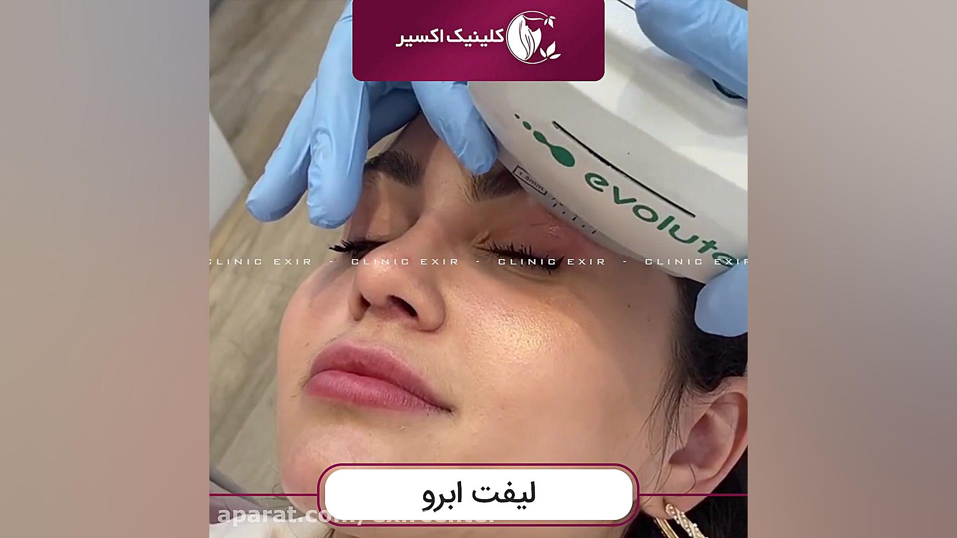 لیفت ابرو با هایفو MRCP
