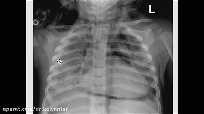 خواندن گرافی قفسه سینه فیلم شماره8 دکتر مجید کیوانفر