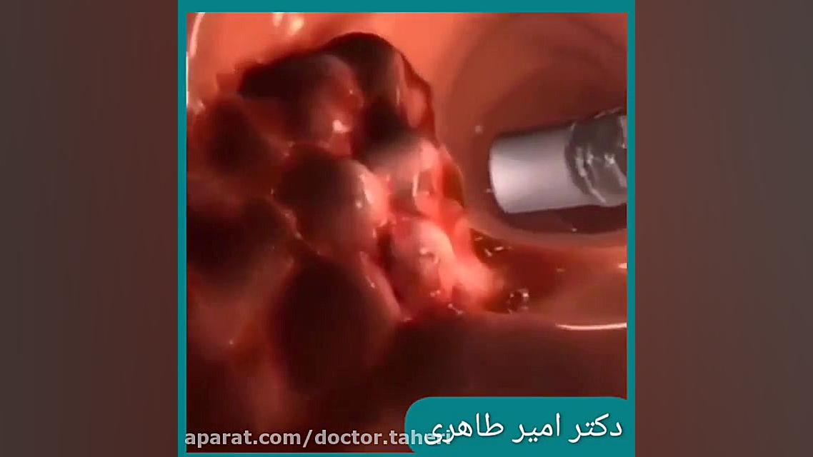 انیمیشن کولونوسکوپی لیپوساکشن