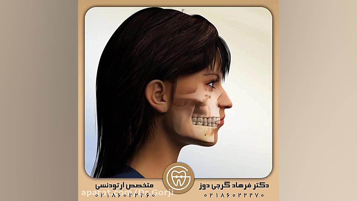 درمان لبخند لثه ای با جراحی فک | دکتر فرهاد گرجی دوز GRO-Seq