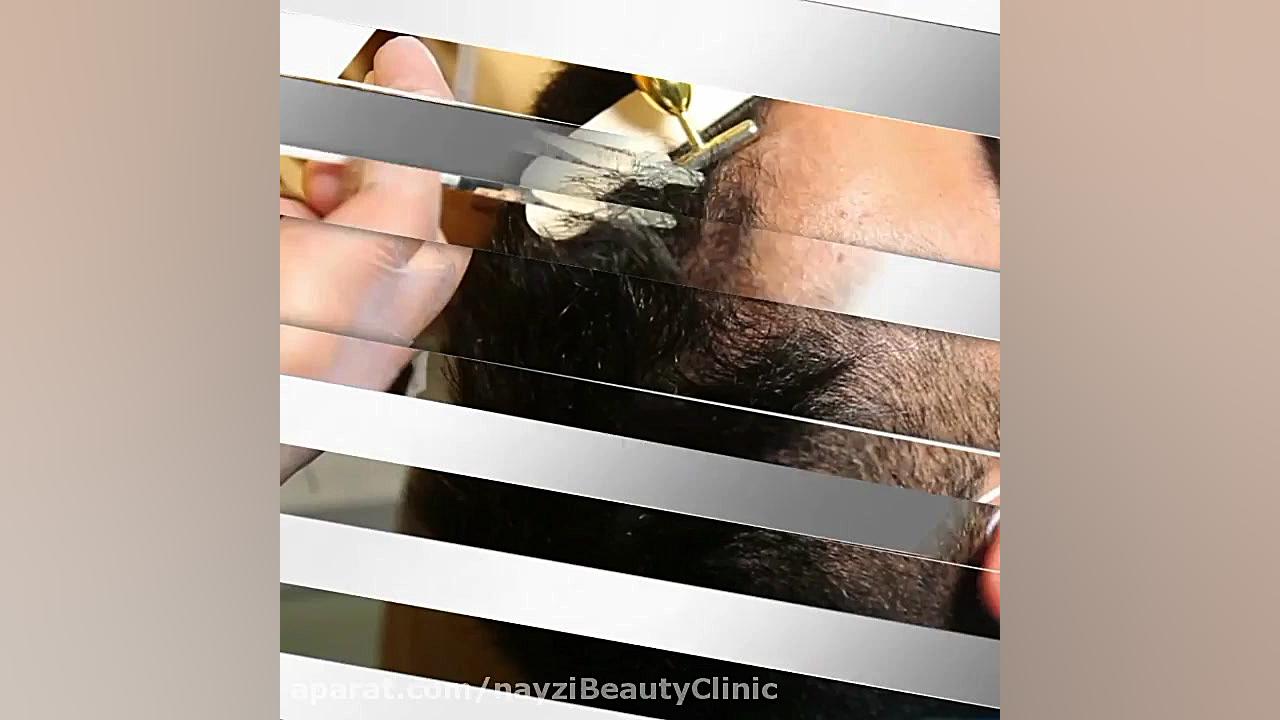 تزریق مزوتراپی | درمان ریزش مو و تقویت موها میوکلونوس