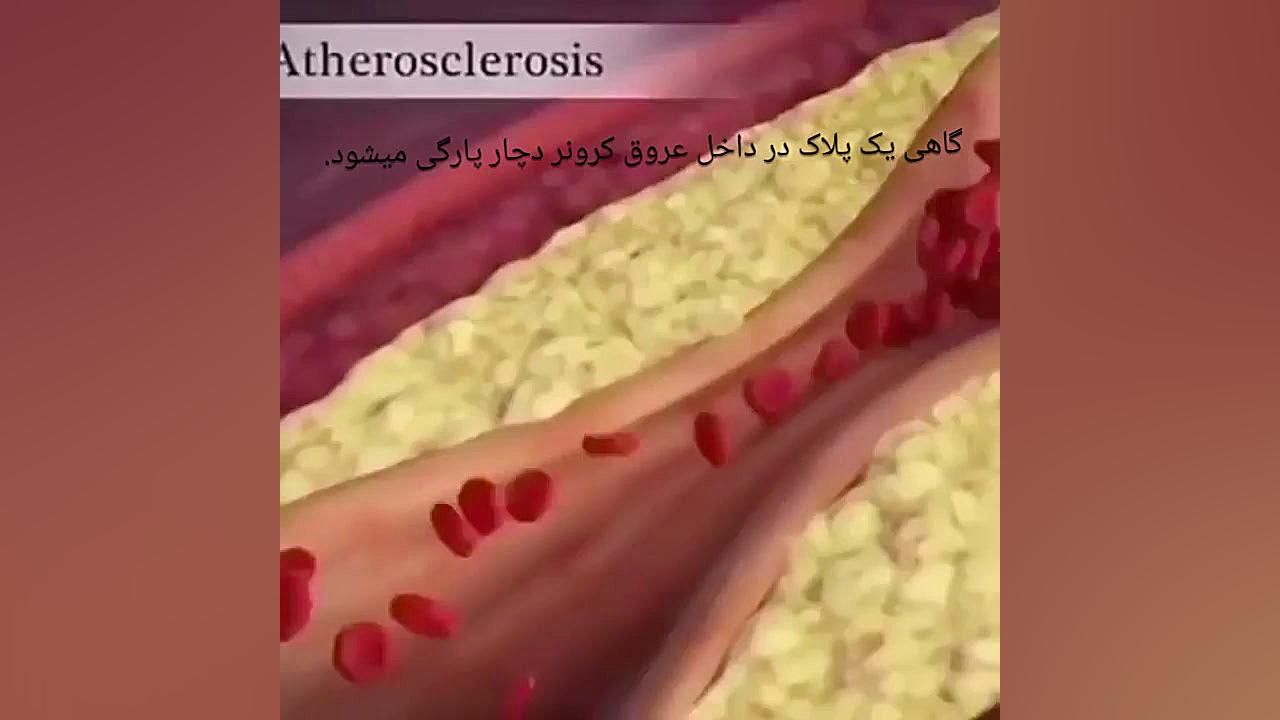 سکته قلبی و معرفی دکتر میلاد انوری متخصص قلب و عروق اکستنشن تاج دندان