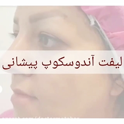 جراحی لیفت آندسکوپ پیشانی