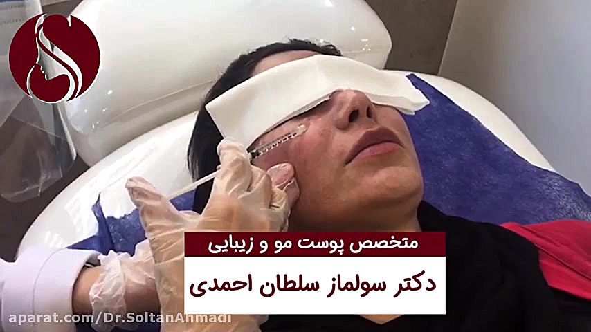 فیلم از بین بردن لک حاملگی (مزوتراپی ترنسید) آزمایش شمارش رتیکولوسیت