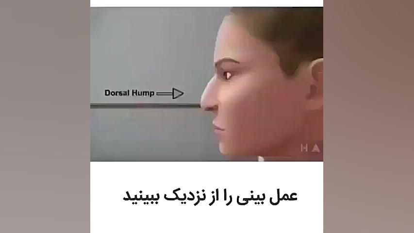 عمل بینی میلوشل