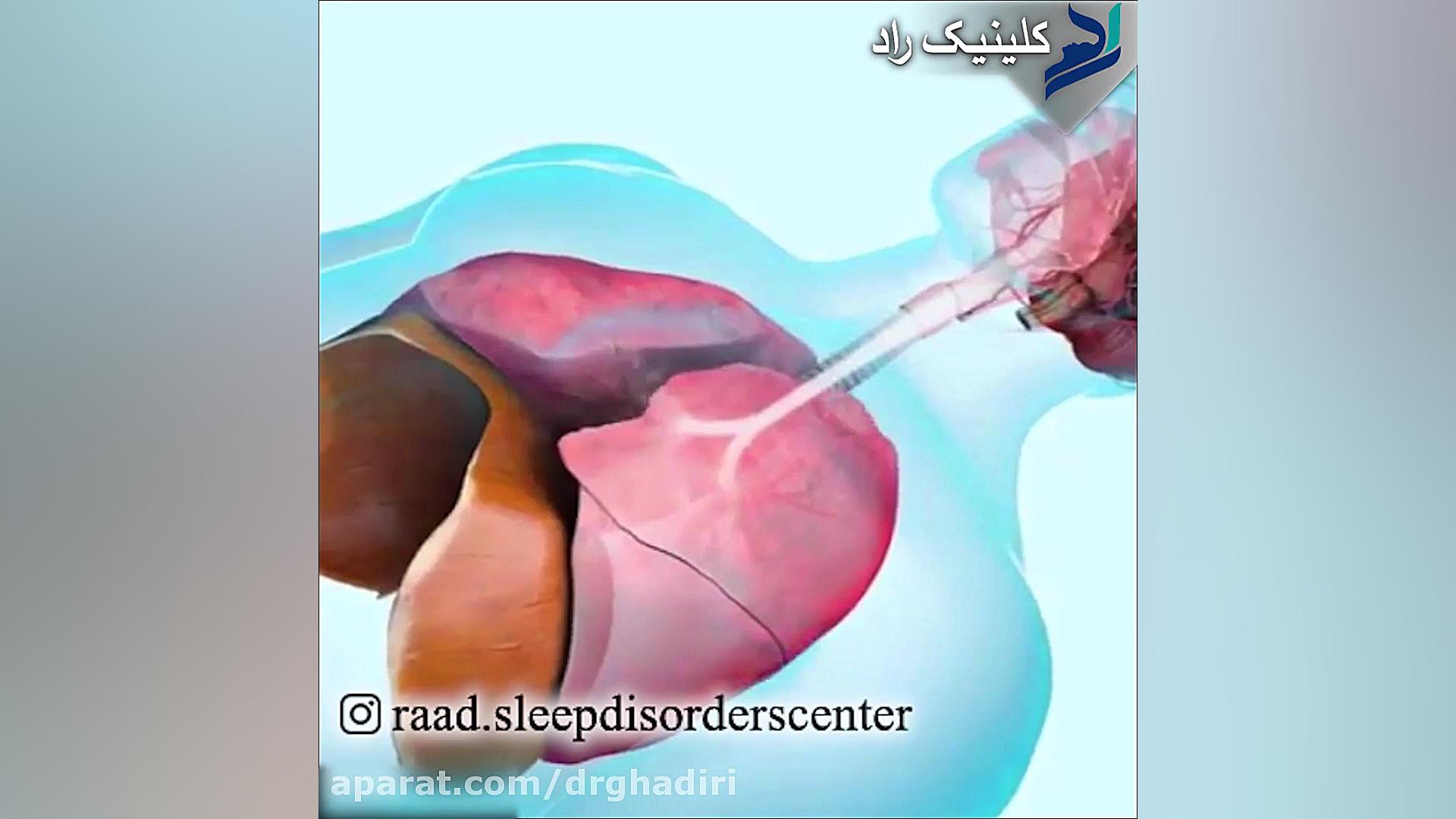 آپنه خواب یا وقفه تنفسی در خواب دکتر مهدی قدیری