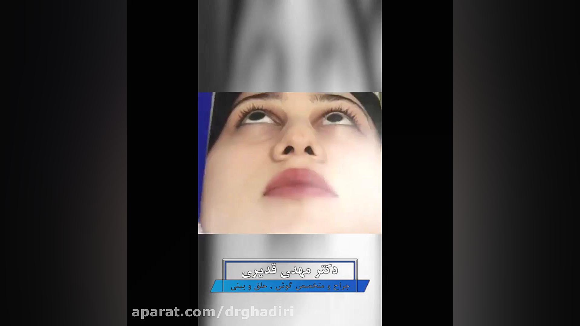 عمل زیبایی بینی توسط دکتر مهدی قدیری دکتر مهدی قدیری