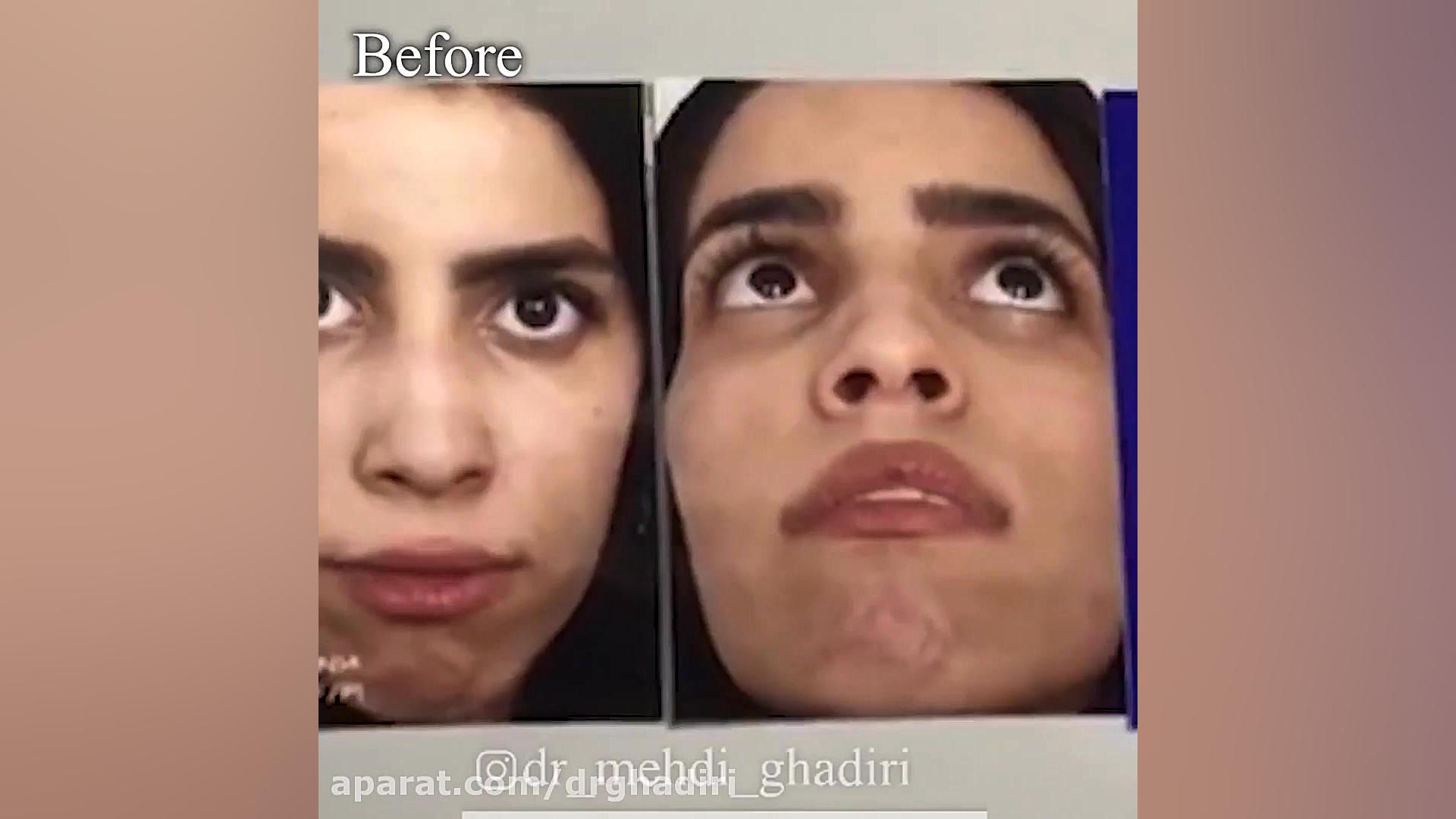 عمل زیبایی بینی توسط دکتر قدیری دکتر مهدی قدیری
