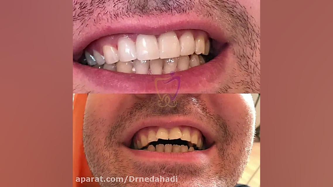 طراحی لبخندی زیبا برای شما دکتر ندا هادی-دندانپزشک زیبایی