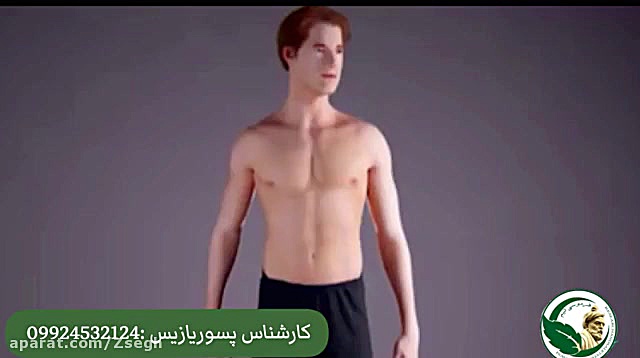 بیماری پسوریازیس و درمان قطعی آن آکنه