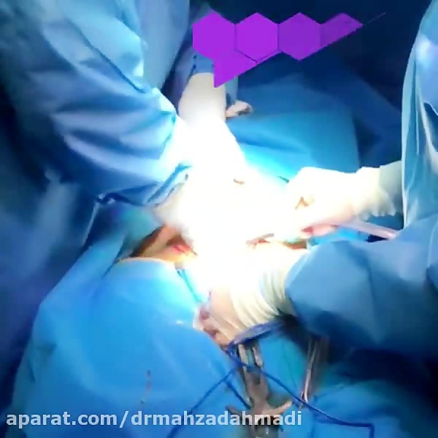 زایمان سزارین