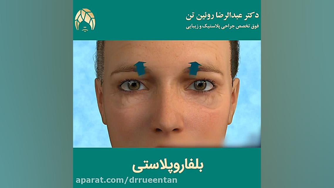 بلفاروپلاستی | فوق تخصص جراحی پلاستیک | دکتر عبدالرضا روئین تن دکتر عبدالرضا روئین تن