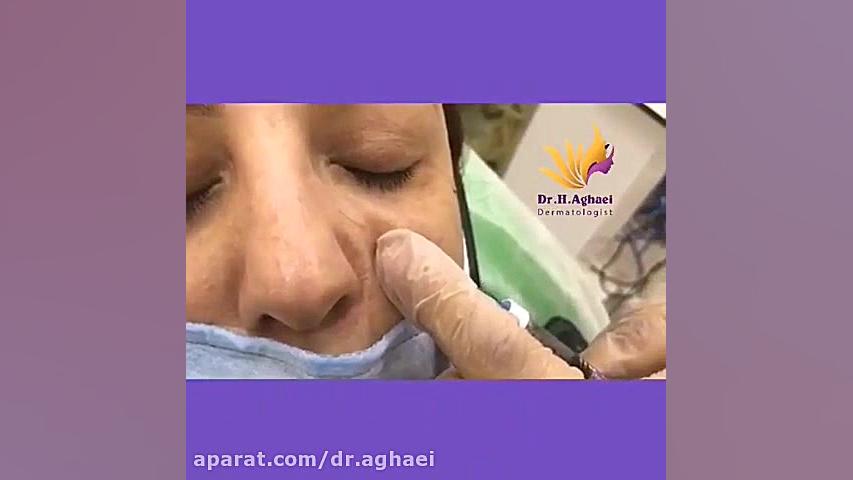 فیلم تزریق ژل زیر چشم دکتر حمیده آقایی
