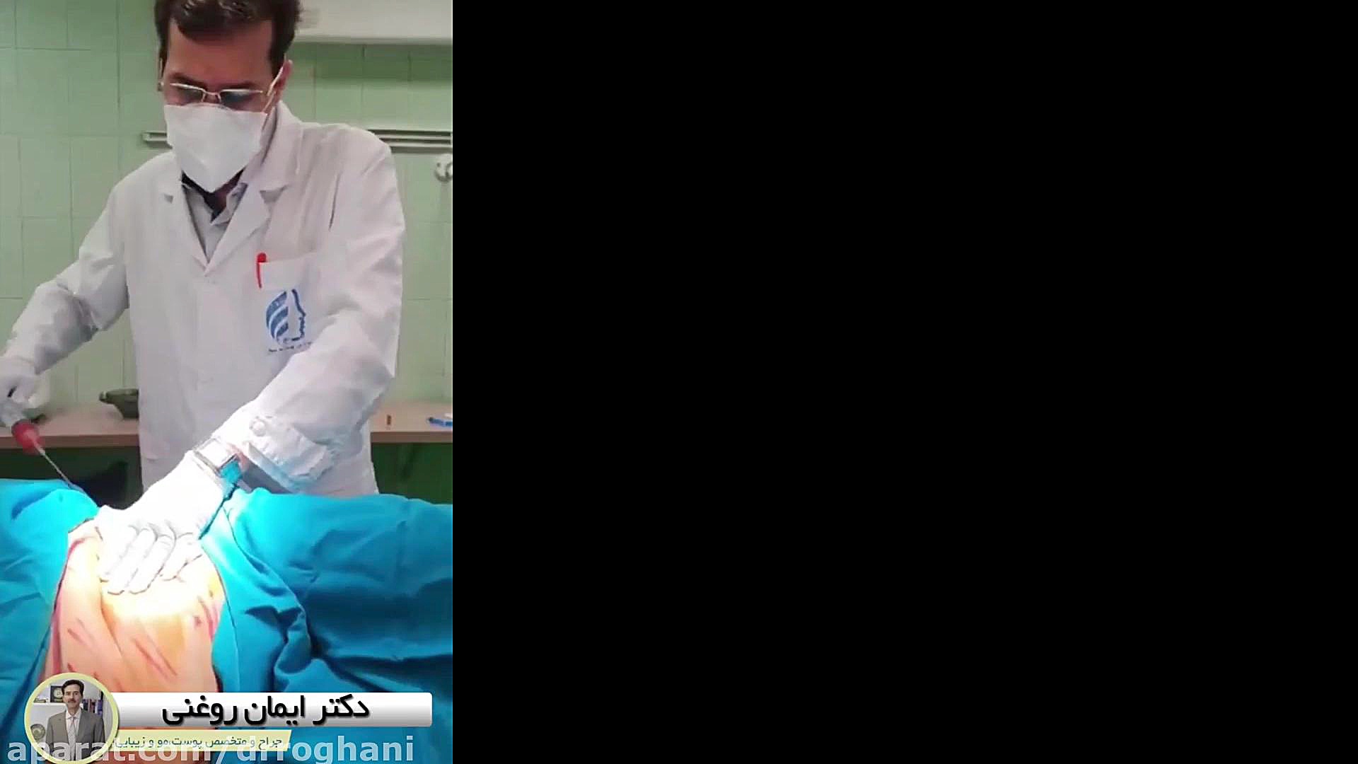فیلم تزریق چربی به صورت دکتر ایمان روغنی جراح و متخصص پوست و مو
