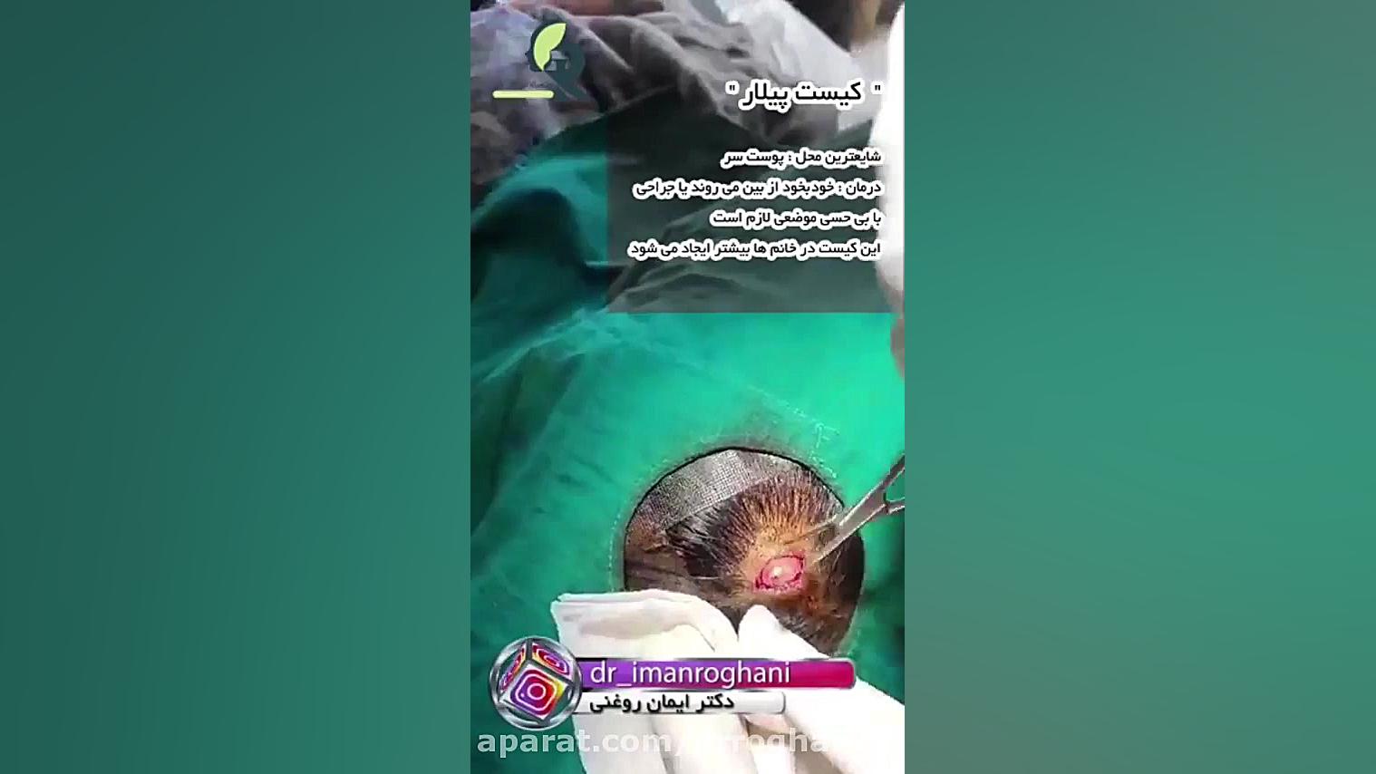 فیلم جراحی برداشتن کیست پیلار دکتر ایمان روغنی جراح و متخصص پوست و مو