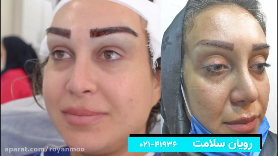 فیلم کاشت ابرو در در کلینیک تهران کاشت ابرو