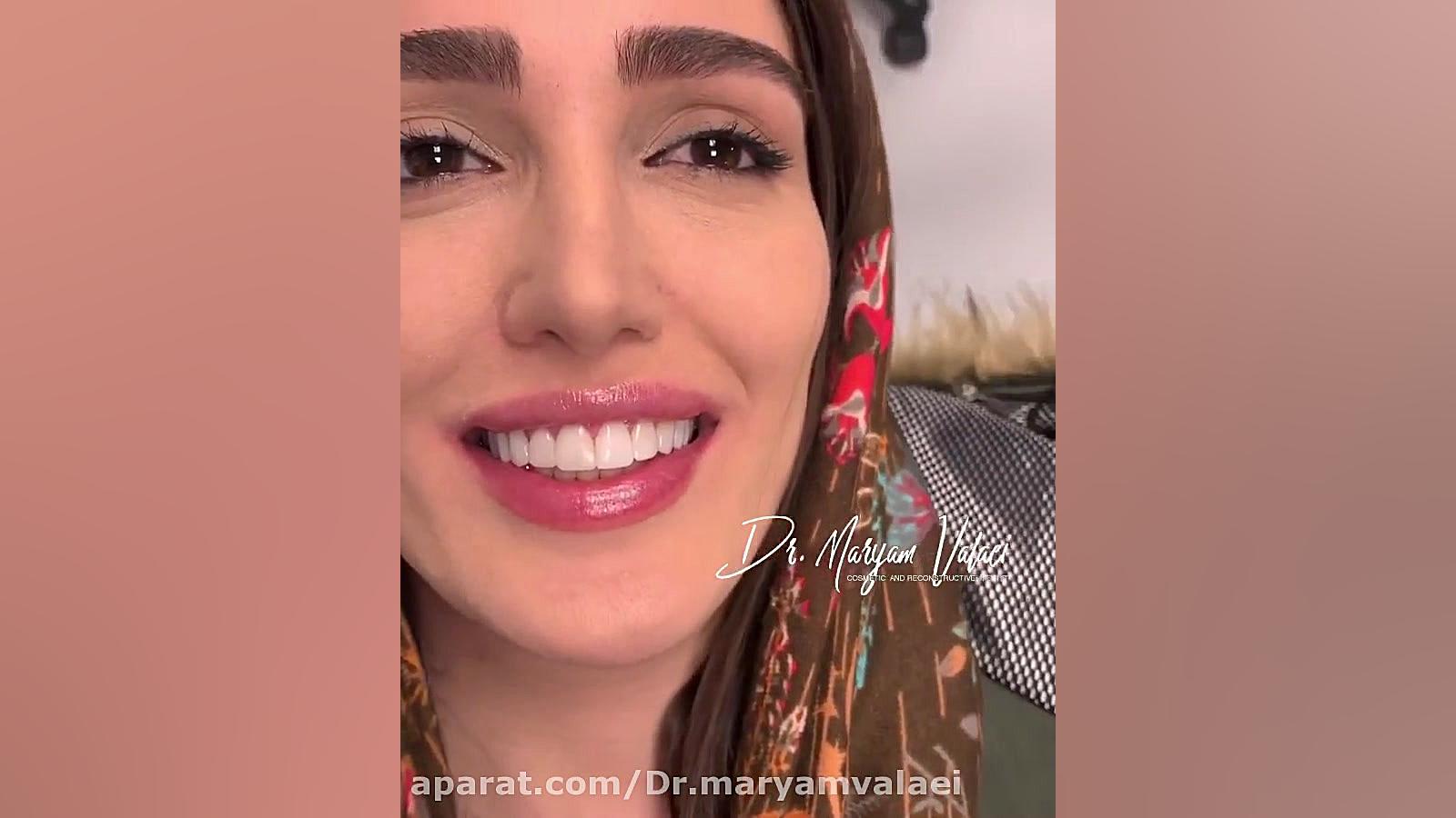 اصلاح بدفرمی و بدرنگی به روش کامپوزیت ونیر با ۱۰ واحد کامپوزیت ای پی اس کولفی‌تیل