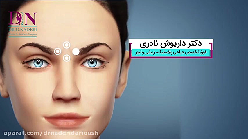 تزریق ژل بهتر است یا بوتاکس؟ رفع افتادگی پلک