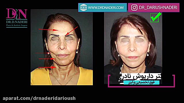 عمل جراحی لیفت صورت، گردن و پیشانی دستگاه DNA-Chip