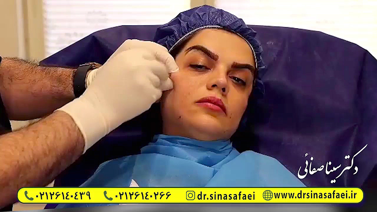 لیفت صورت با نخ سیلوئت فرمانزوماب