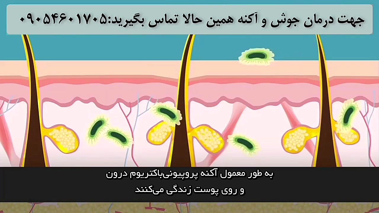 چه چیزهای باعث بوجود آمدن جوش صورت میشود دندان پیش