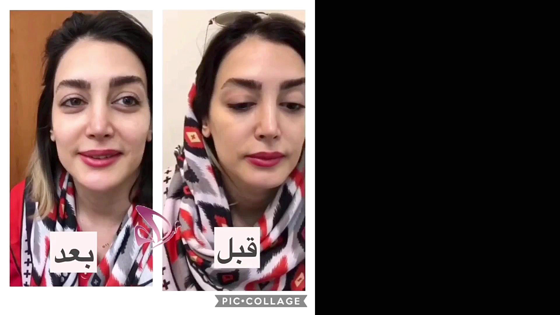 زاویه سازی صورت با استفاده از تزریق ژل پلاستیک لثه