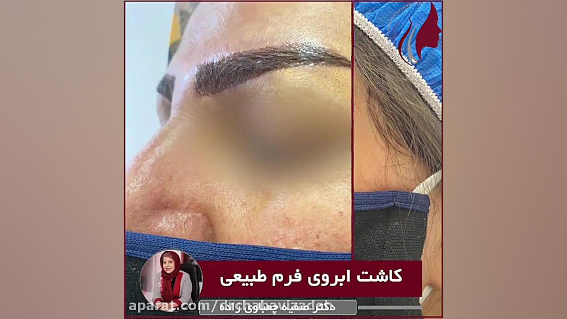 فیلم نمونه واقعی کاشت ابروی طبیعی دکتر صفیه چعباوی زاده