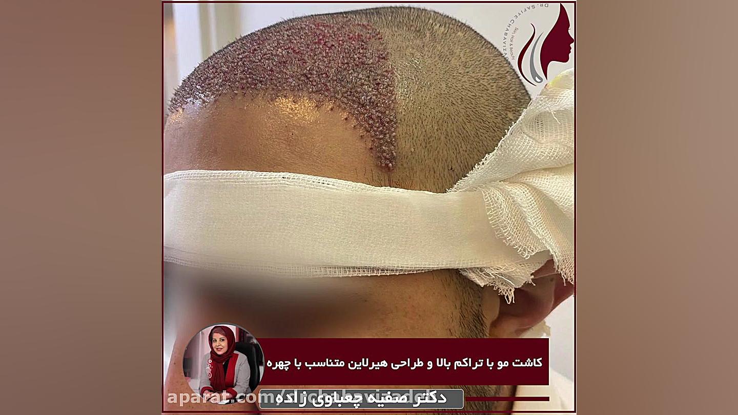 فیلم واقعی کاشت مو با تراکم بالا و طراحی هیر لاین متناسب با چهره دکتر صفیه چعباوی زاده