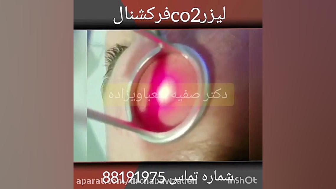 فیلم کاربرد ليزر co2 فركشنال براي مشكلات پوستی دکتر صفیه چعباوی زاده