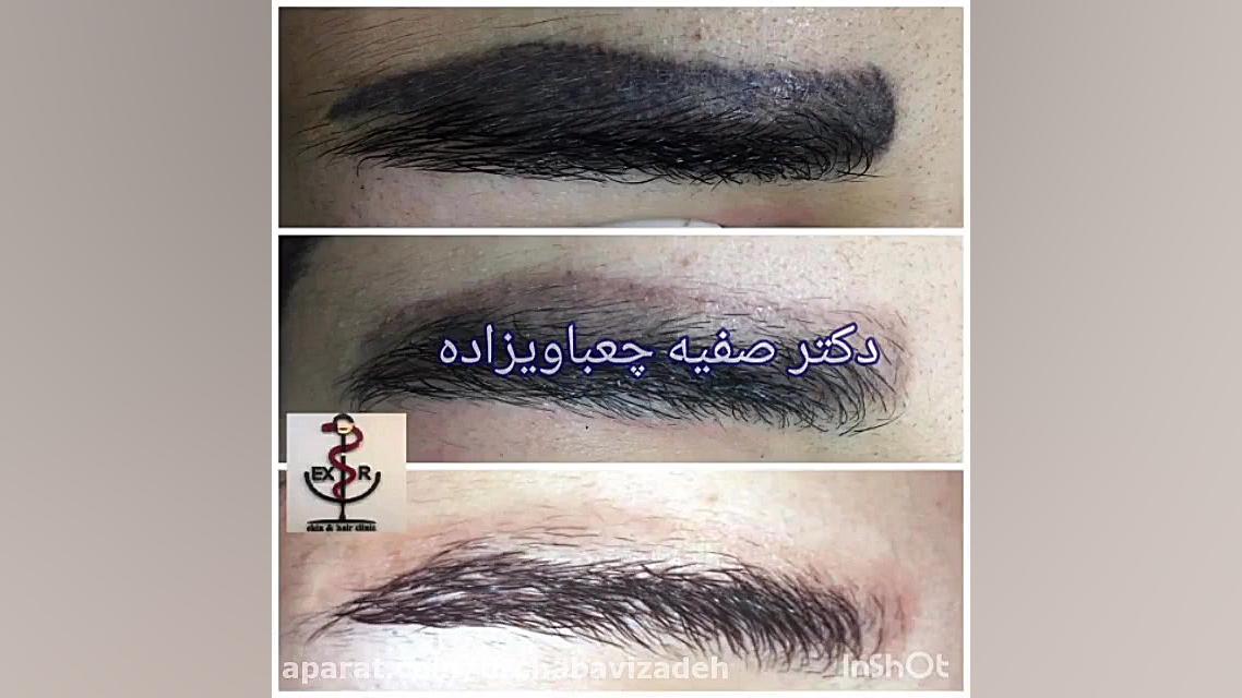 فیلمی از نمونه های واقعی لیزر تاتو ریموال ابرو دکتر صفیه چعباوی زاده