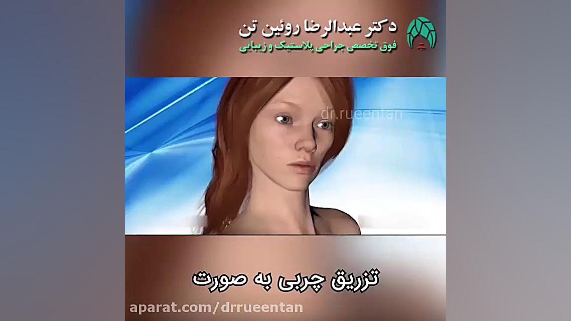 تزریق چربی به صورت | فوق تخصص جراحی پلاستیک | دکتر عبدالرضا روئین تن دکتر عبدالرضا روئین تن