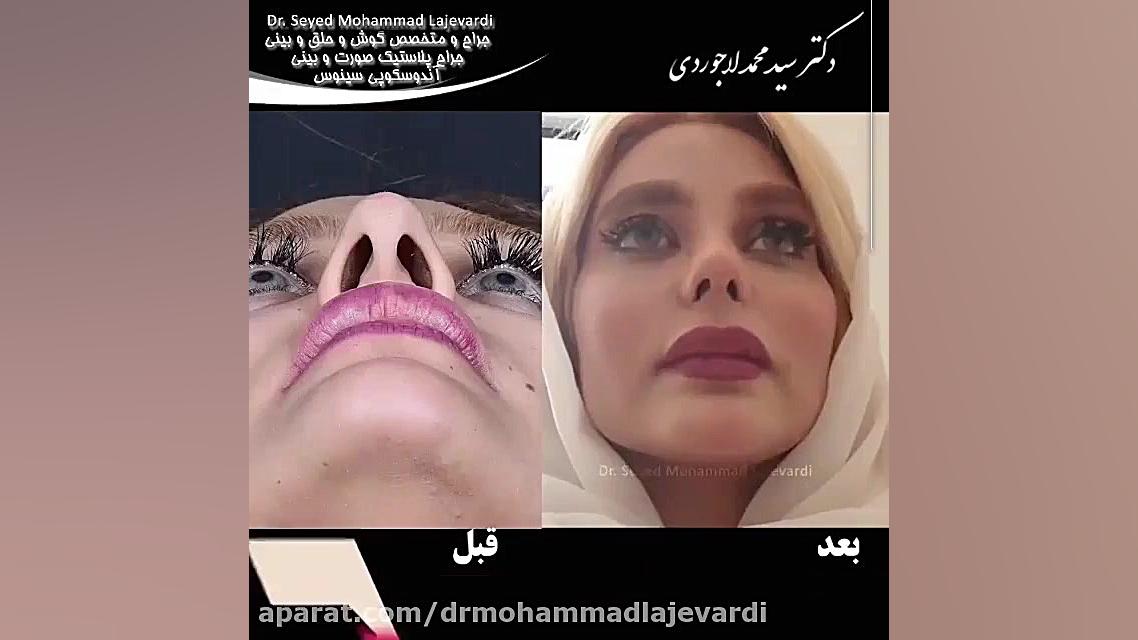 جراحی زیبایی بینی بدون بیهوشی دکتر پوست