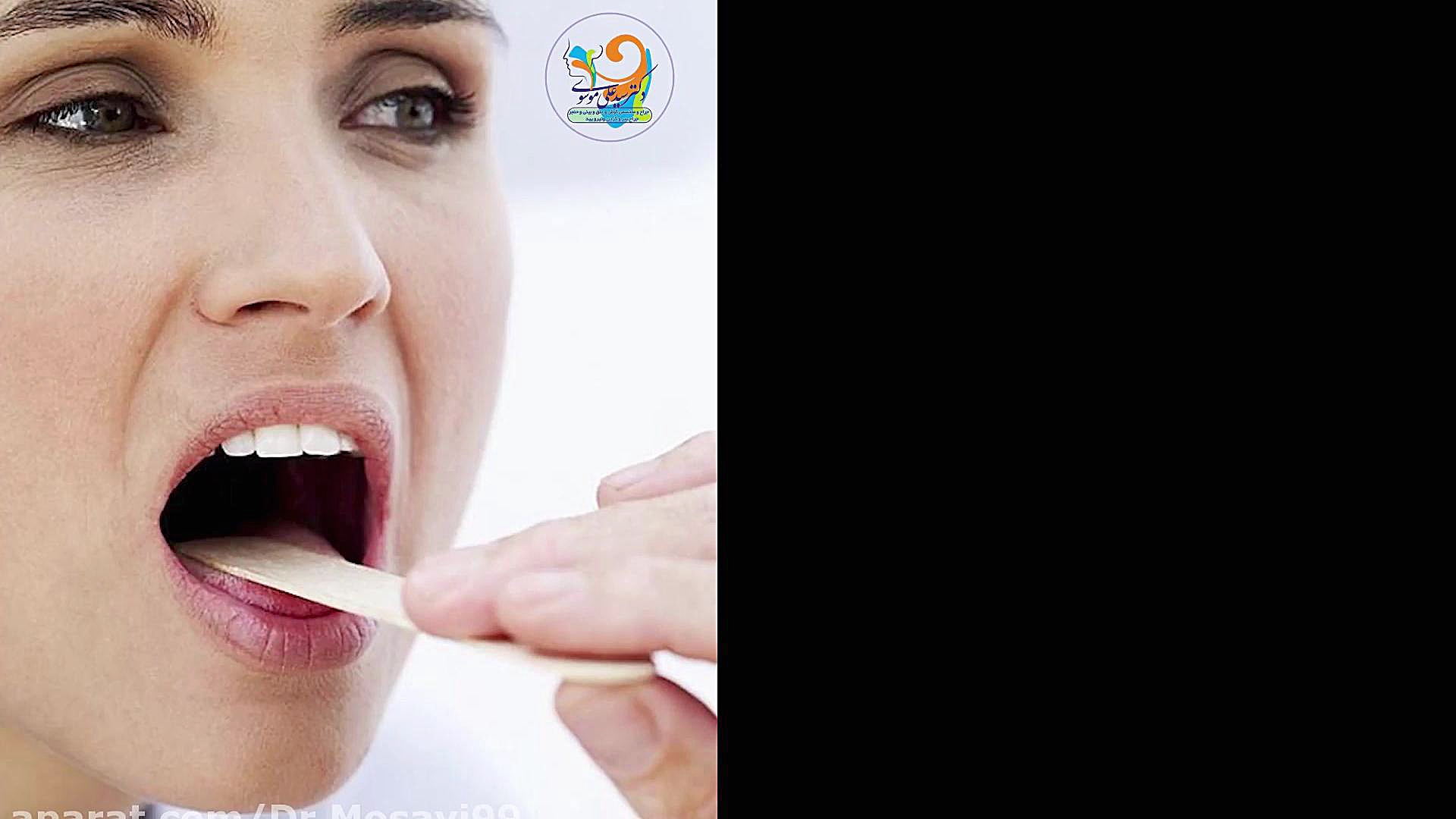 سرطان زبان چگونه تشخیص داده می شود؟ کاشت مو