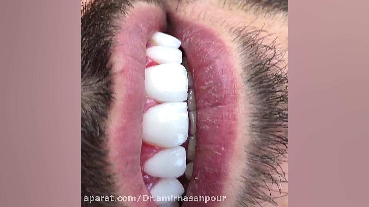 لامینیت سرامیک کریستالی دکتر امیر حسن پور دندانپزشک زیبایی اصفهان