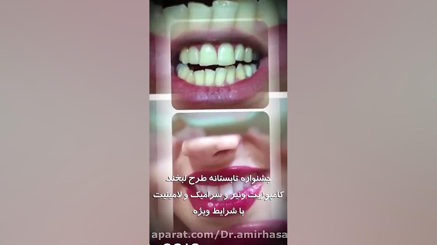 ونیر کامپوزیت دکتر امیر حسن پور دکتر زیبایی اصفهان دکتر امیر حسن پور دندانپزشک زیبایی اصفهان