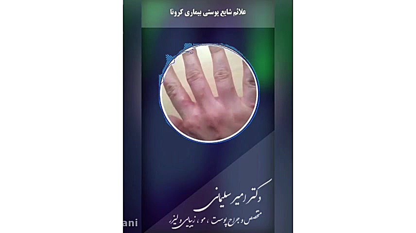 جدید ترین علائم ویروس کرونا بر پوست دکتر امیر سلیمانی
