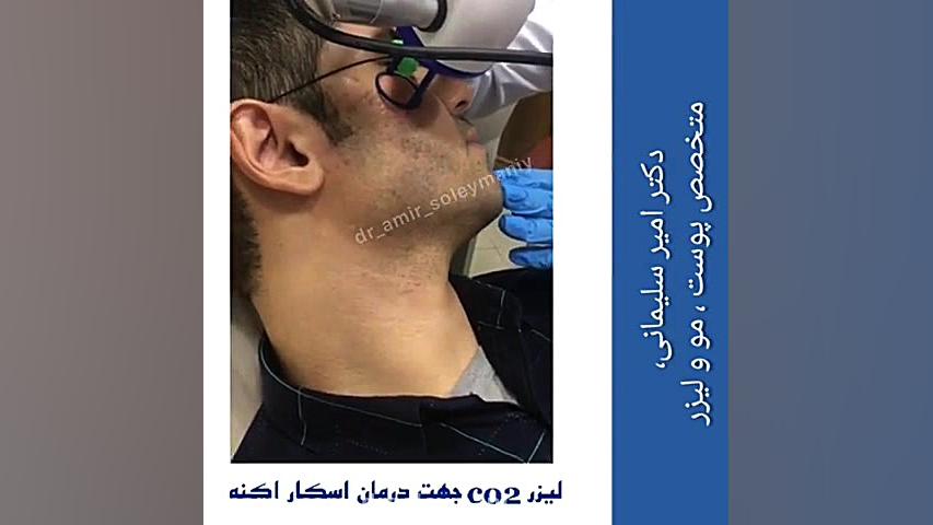 فیلم واقعی رفع اسکار آکنه با لیزر co2 دکتر امیر سلیمانی
