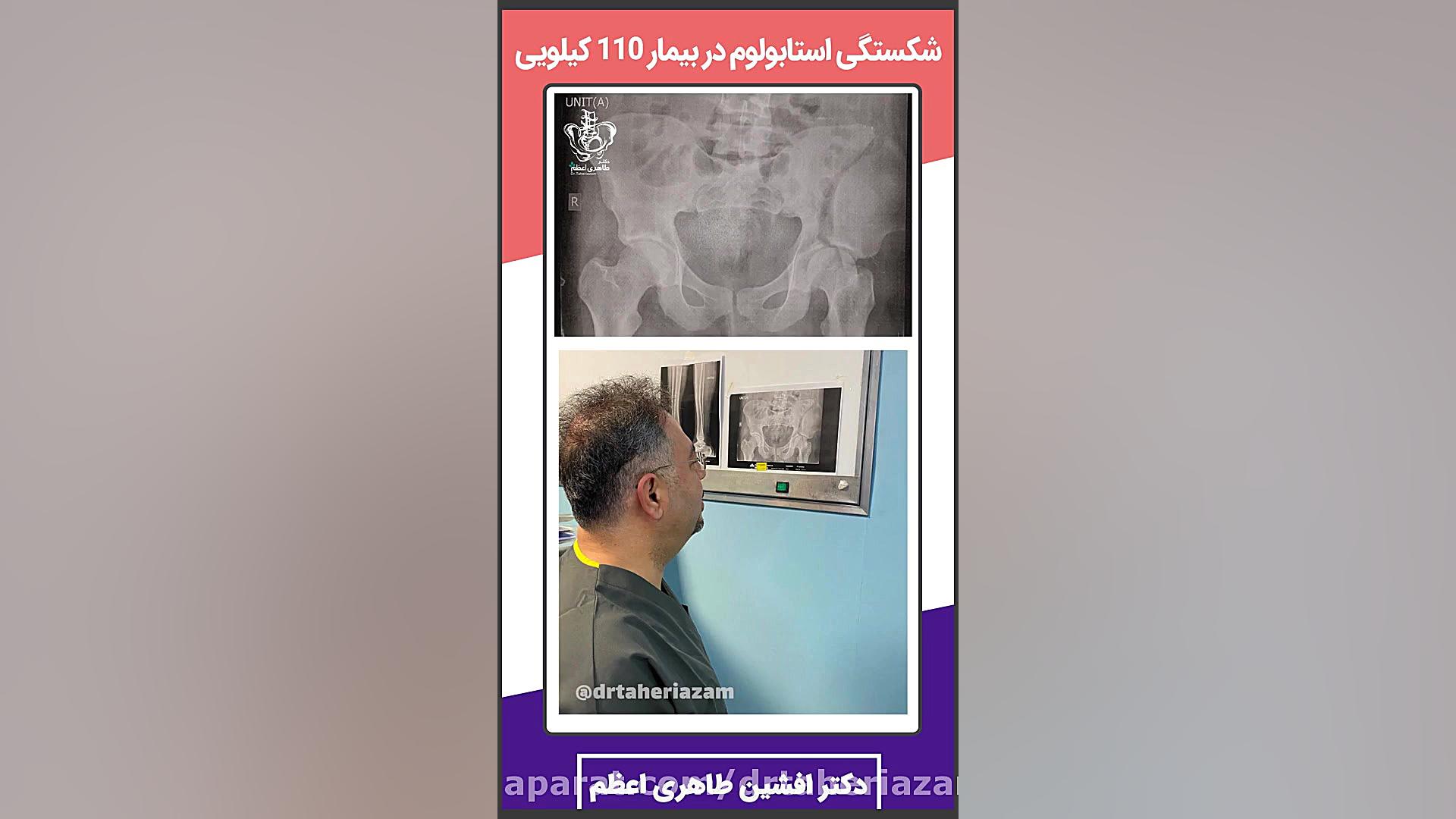 شکستگی استابولوم در یک بیمار 110 کیلویی !!!! مایکل جردن