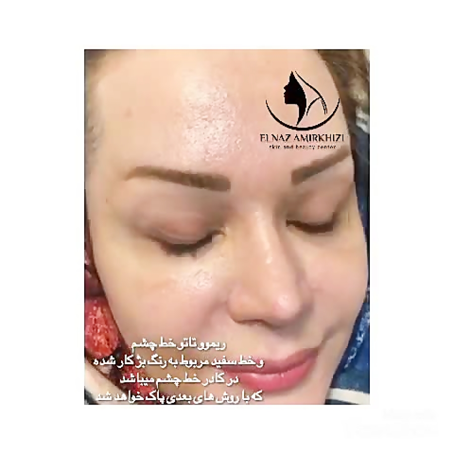 ریموو تاتوی خط چشم - کلینیک تخصصی زیبایی ال کلینیک