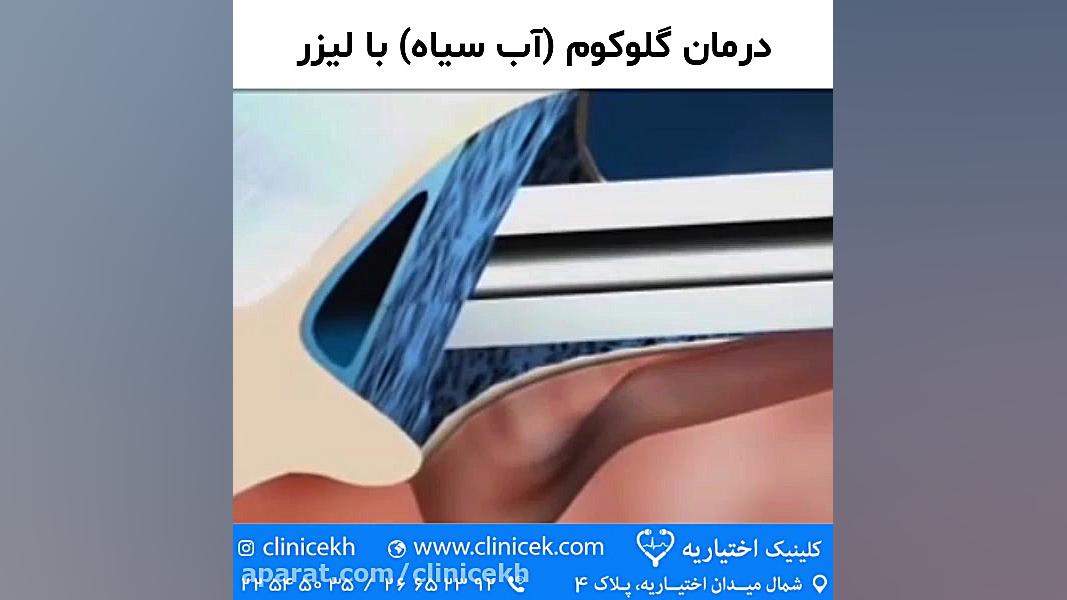 درمان گلوکوم (آب سیاه) با لیزر رادیوگرافی دندان