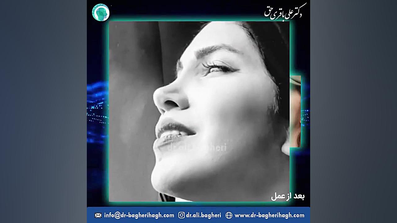قبل و بعد از جراحی بینی دکتر علی باقری حق